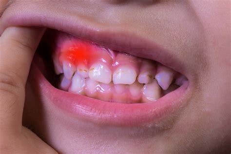Gum disease in a child's mouth