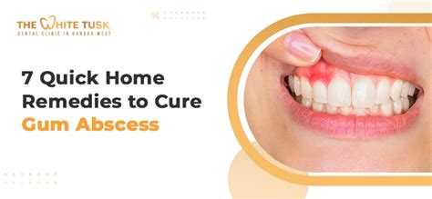 Gum Abscesses: Fast Relief & Effective Treatment