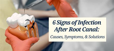 Gum Infection After Root Canal