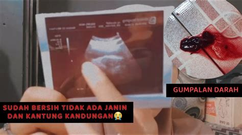 Gumpalan Darah saat Hamil Muda di Indonesia