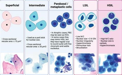 HSIL Cytology Test and interpretation