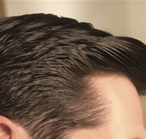 Hair Growth Operations: Patient Testimonials