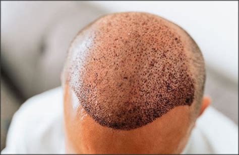 Hair Implants