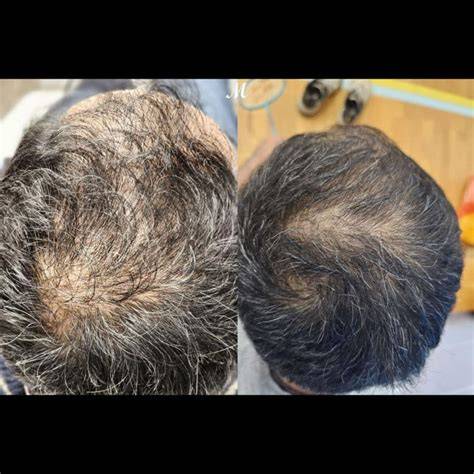 Hair Loss FAQs