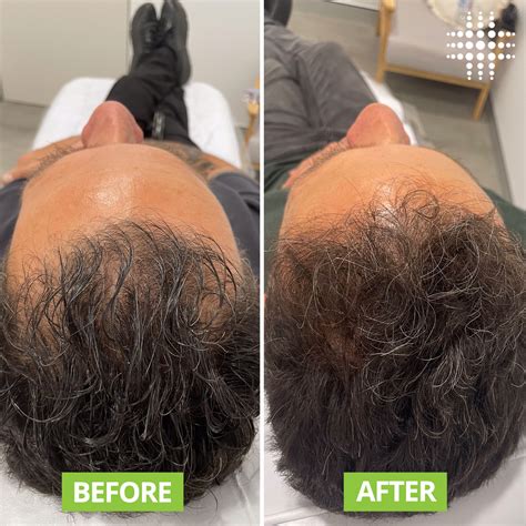 Hair Regrowth