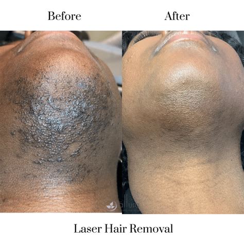Effective Hair Removal Solutions for Dark Skin Types
