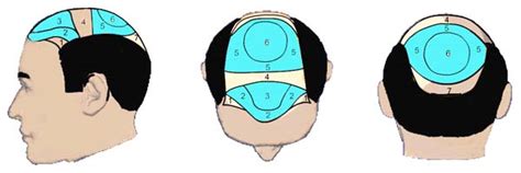 Hair Transplant Calculator