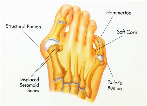 Hammertoe foot anatomy