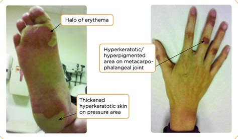 The Astonishing Truth about Hand-Foot Skin Reactions: Symptoms, Causes and Treatments Unveiled!
