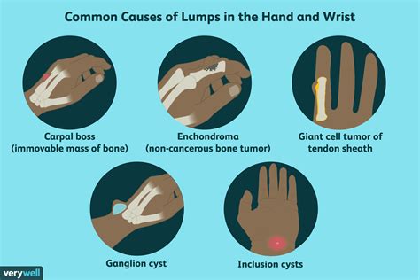 Hand Lumps: Causes & What to Do