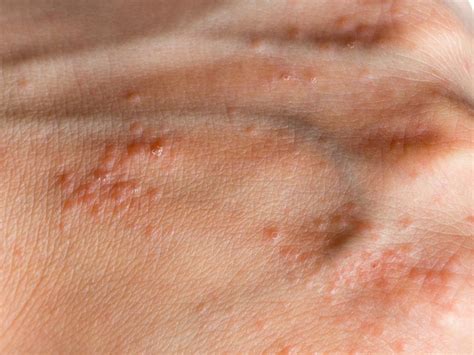 Hand Pimples: Causes & Fast Prevention Tips