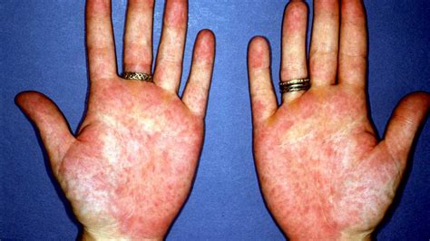 Hand Spots: Causes & Effective Treatments