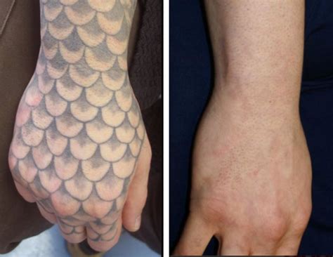 tattoo removal on face wrist tattoo removal before and