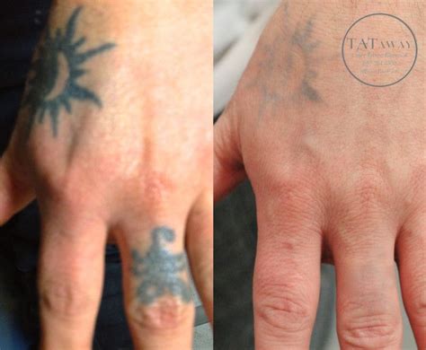 Hand Tattoo Removal