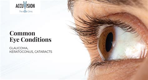 Handling Complex Eye Conditions (Cataracts, Glaucoma)