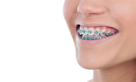 Harga Behel Gigi di Klinik Dokter