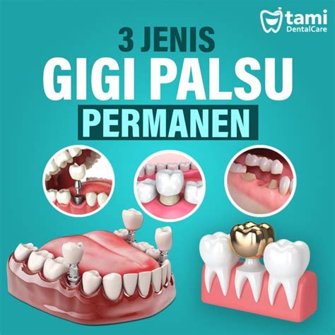 Harga Gigi Geraham Permanen Palsu di Indonesia