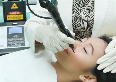 Harga Perawatan Laser Peel di Natasha Skin Care