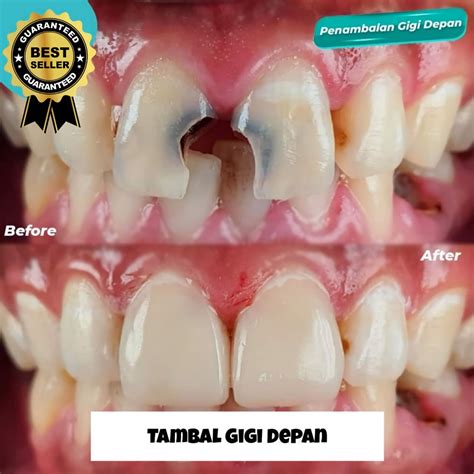 Harga Tambal Gigi Geraham Permanen