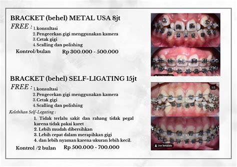 Harga Behel Permanen Atas