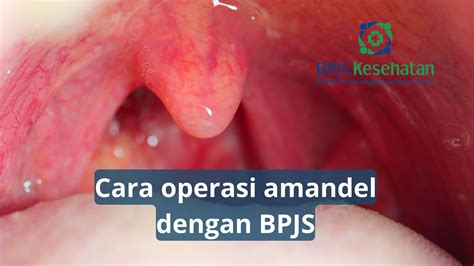 Harga Operasi Amandel BPJS