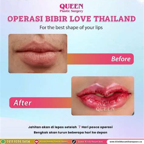 Harga Operasi Bibir Tipis