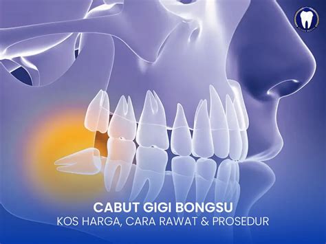 Harga Operasi Gigi Bongsu: Kos dan Perkiraan Kos Operasi di Malaysia