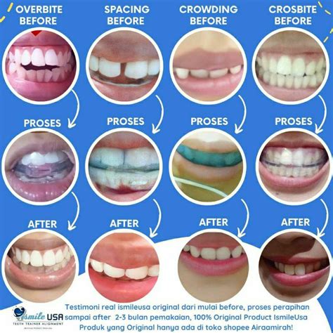 Harga Retainer Gigi Transparan