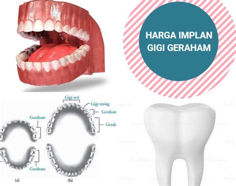 Harga Tanam Gigi Geraham dan Manfaatnya