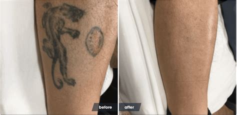 Healed Tattoo Removal