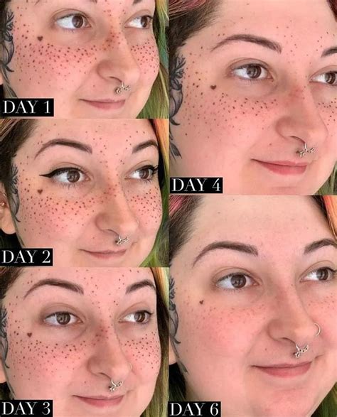 Healed Tattooed Freckles