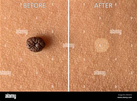5 Effective Tips for Fast Healing After Skin Tag Removal