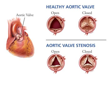 Healthy Aging Aortic Stenosis