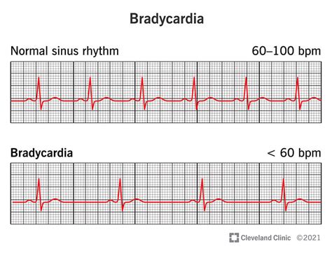 An image illustrating the concept of healthy aging bradycardia