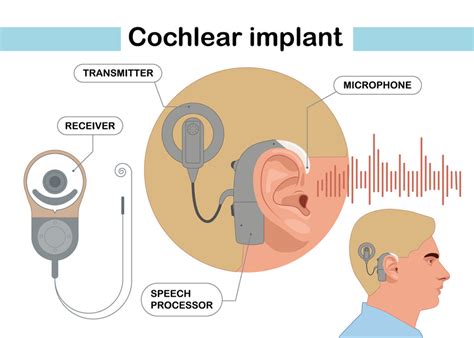 Hearing Loss and Cochlear Implants