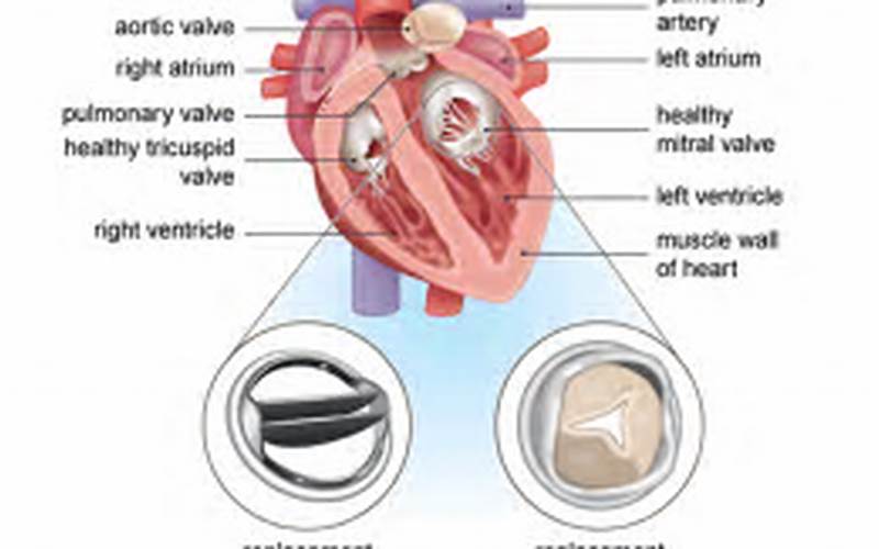 Heart Valve Replacement Procedure