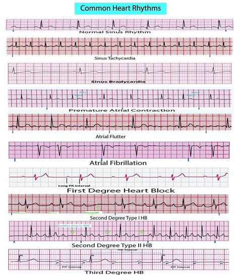 Heart Rhythm Chart