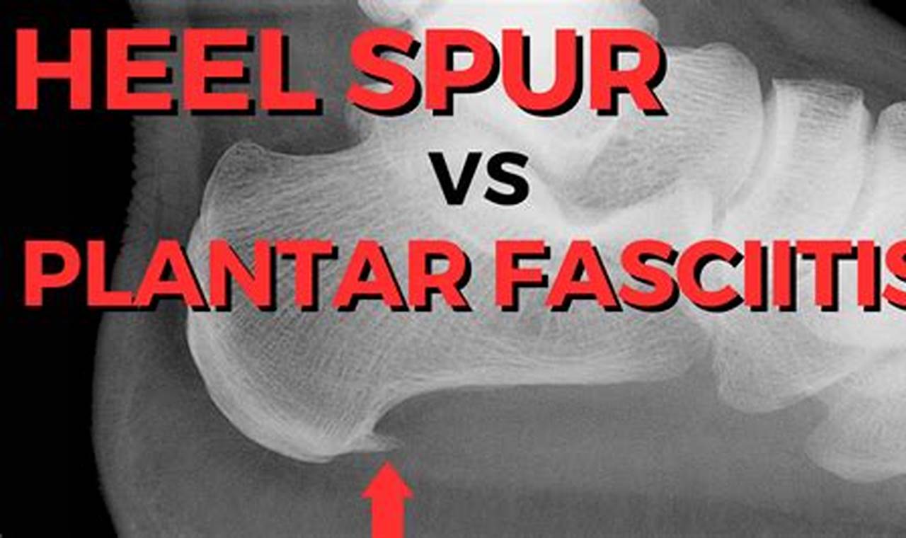 Heel Spur Vs Plantar Fasciitis