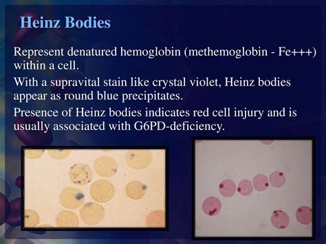 Heinz Body Preparation Test and interpretation