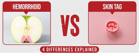 Hemorrhoids vs Skin Tags: Differences, Causes and Treatments.