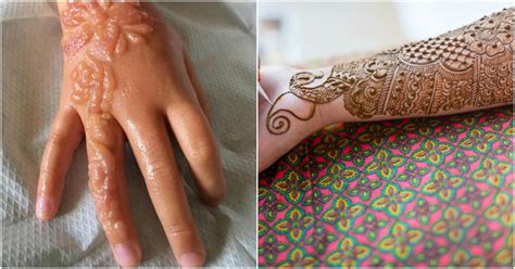 Girl, 7, suffers horrific burns from henna tattoo ITV News