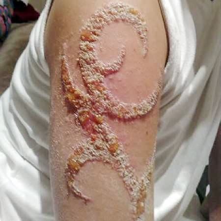 Child left with tiger scar from henna tattoo on holiday