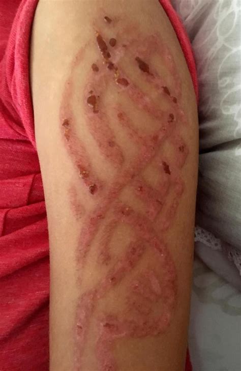 Teenager's holiday henna tattoo 'turned into blistering