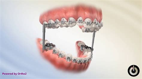 Herbst Appliance Animation