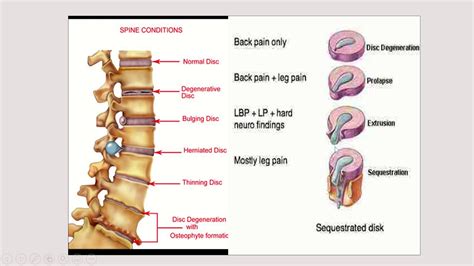 FISIOTERAPI PADA HERNIA NUKLEUS PULPOSUS (HNP) LUMBAL Healthy Insights