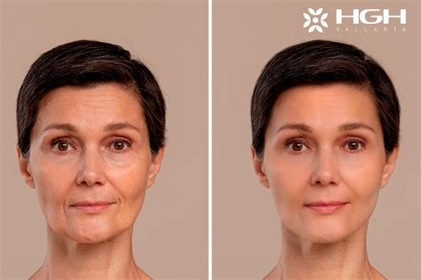 Unleashing the Power of HGH: Witness the Spectacular Transformation of Skin Before and After its Advent!