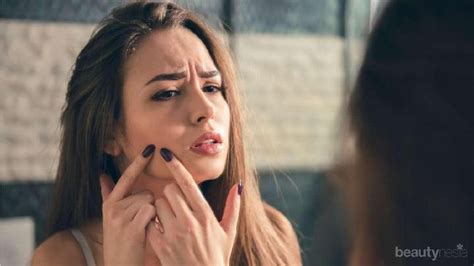 Hindari Memencet Jerawat