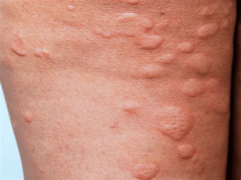 Hives Urticaria