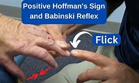 Hoffman's Reflex Sign
