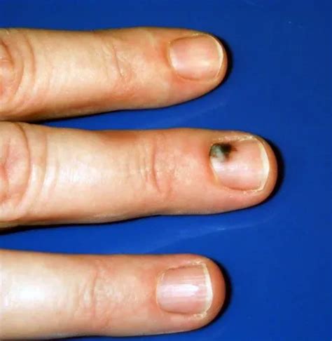The simplest ways to fix an ingrown fingernail